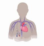 What is a catheter and what is it used for?